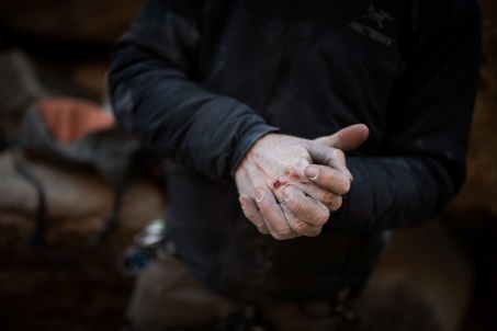 Rock Climbing Scars